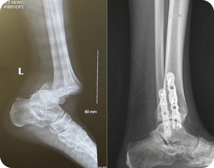 Ankle Trauma After Crush Injury Dr. Kyle McKray Smith