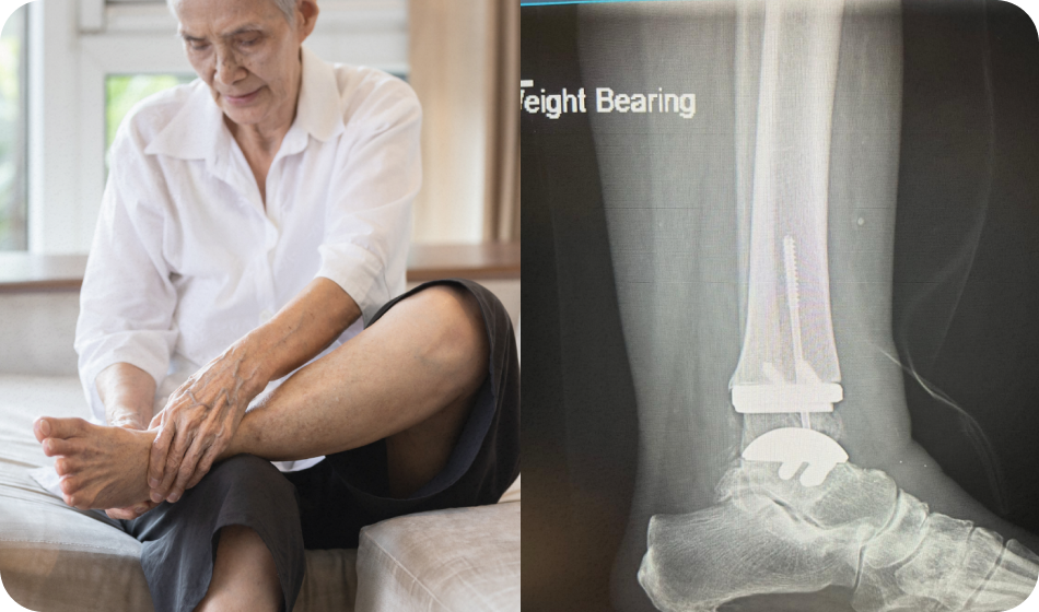 Total Ankle Replacement Dr Kyle McKray Smith