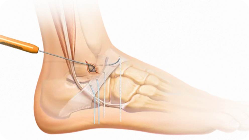 Lateral Ankle Ligament Repair Dr Kyle McKray Smith