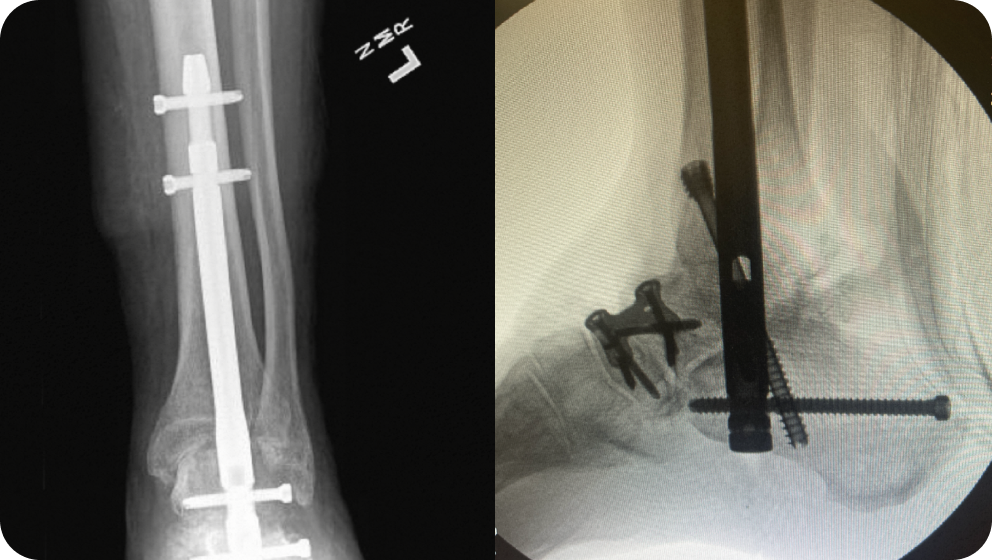 Tibiotalocalcaneal Arthrodesis TTC Fusion Dr Kyle McKray Smith