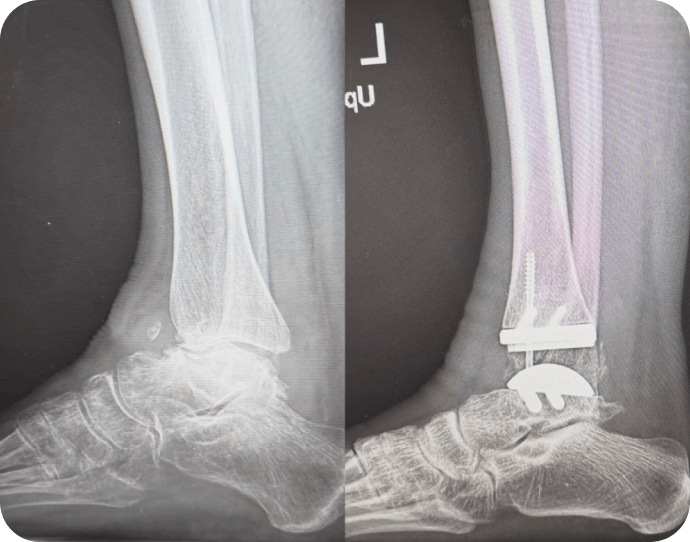 Total Ankle Replacement 1 Dr Kyle McKray Smith