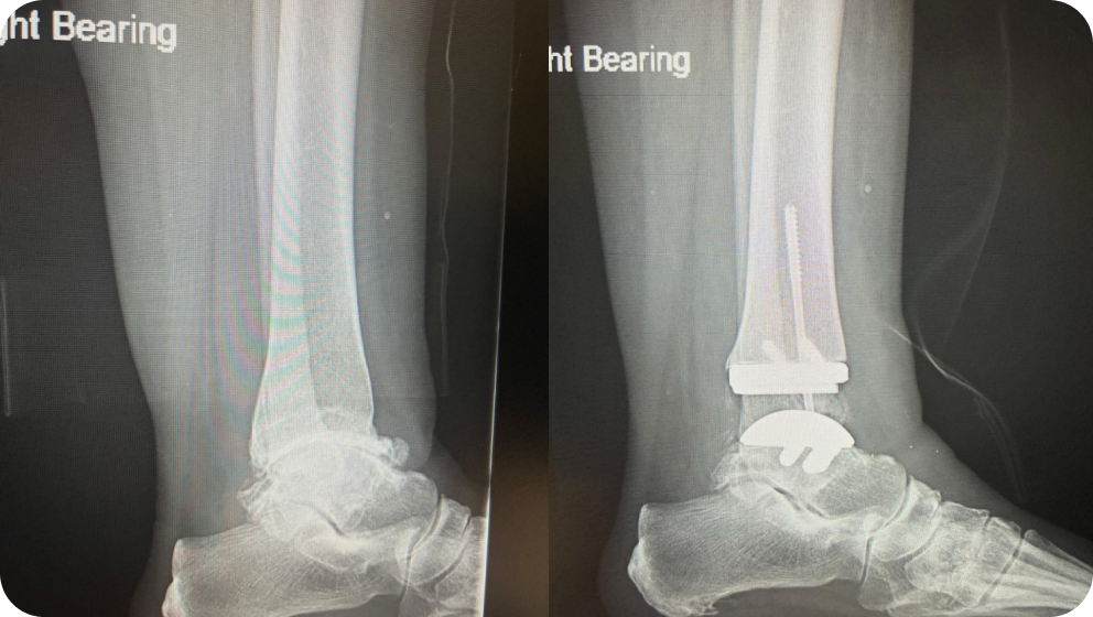 Total Ankle Replacement Dr Kyle McKray Smith