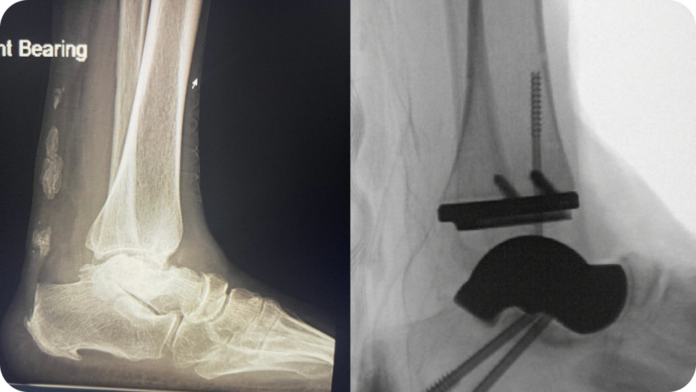 Total Talus Replacement Dr Kyle McKray Smith