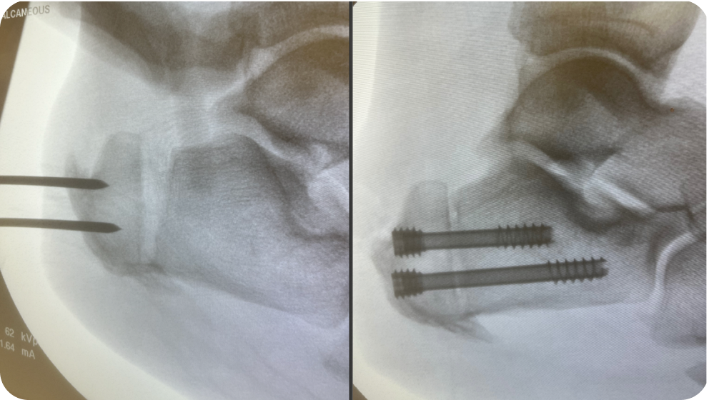Zadek Osteotomy Dr Kyle McKray Smith