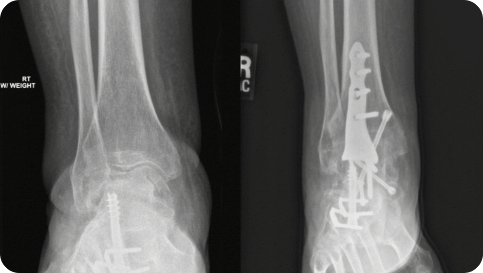 Ankle Fusion vs Total Ankle Replacement -Dr Kyle McKray Smith