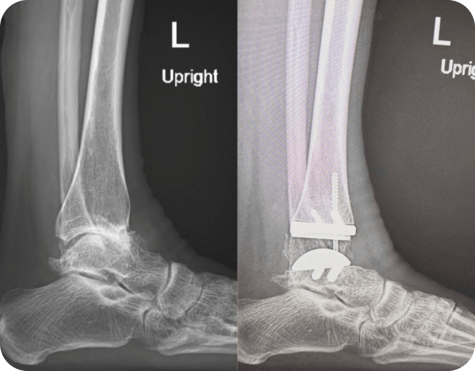 Significant Post-Traumatic Ankle Arthritis -Dr Kyle McKray Smith