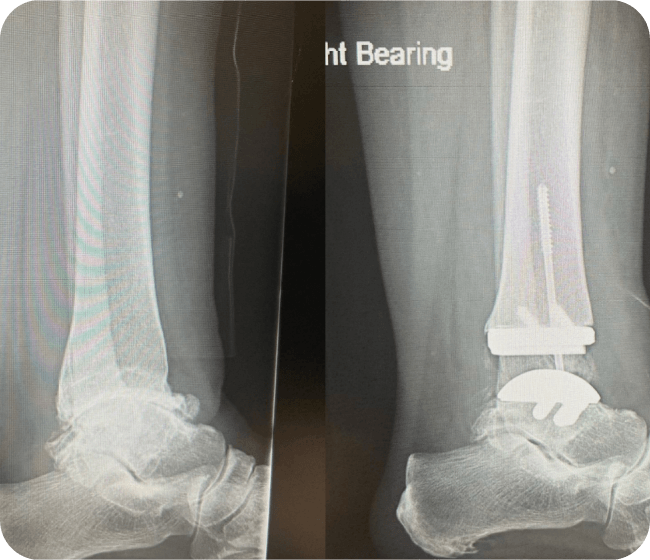Total Ankle Replacement Guide - Dr Kyle McKray Smith