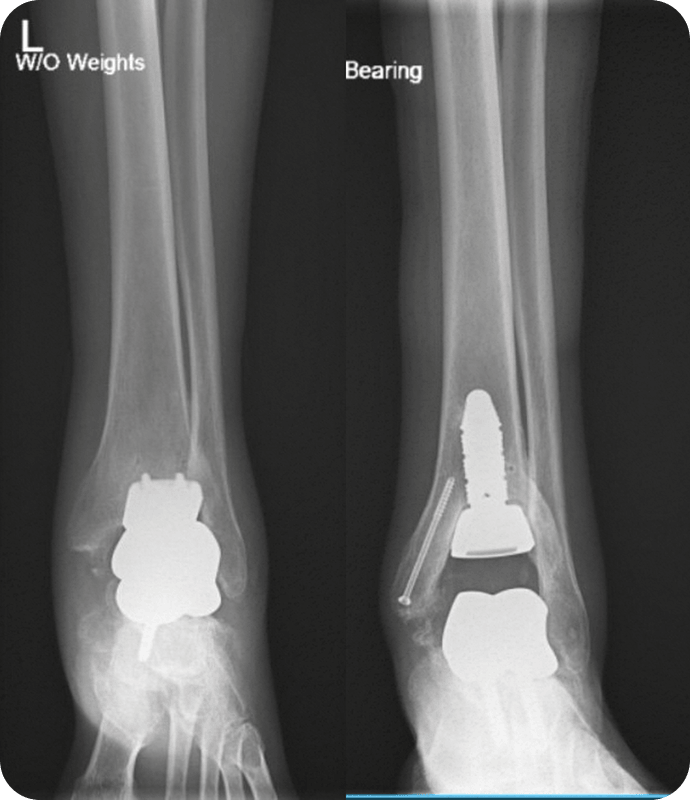 Revision Total Talus Replacement - Dr. Kyle McKray Smith