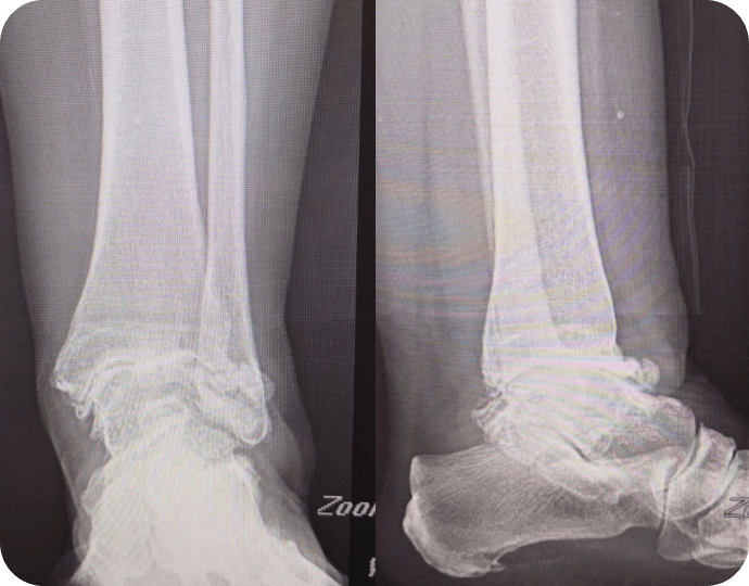 Significant Ankle Arthritis -Dr. Kyle McKray Smith