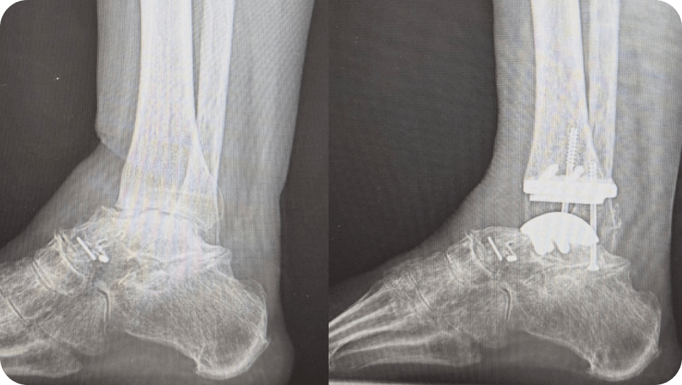 Surgical Treatment Ankle Arthritis -Dr. Kyle McKray Smith
