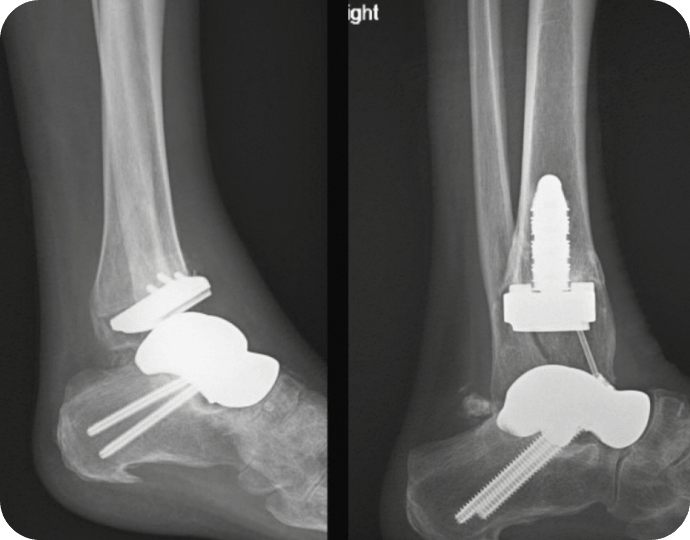 Complex total ankle joint and total talus revision -Dr. Kyle McKray Smith